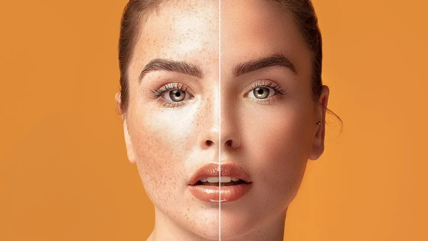 Lézeres pigmentfolt eltávolítás Apollon Beauty kozmetikában