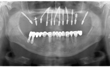 fog implantátum