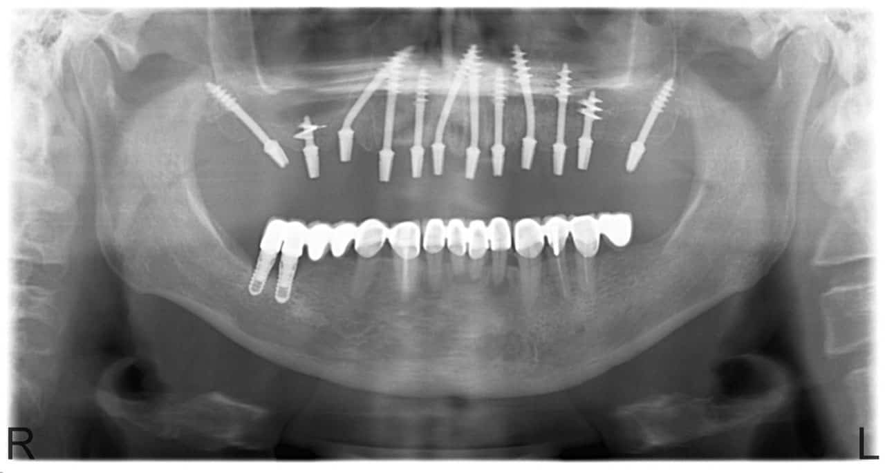 fog implantátum